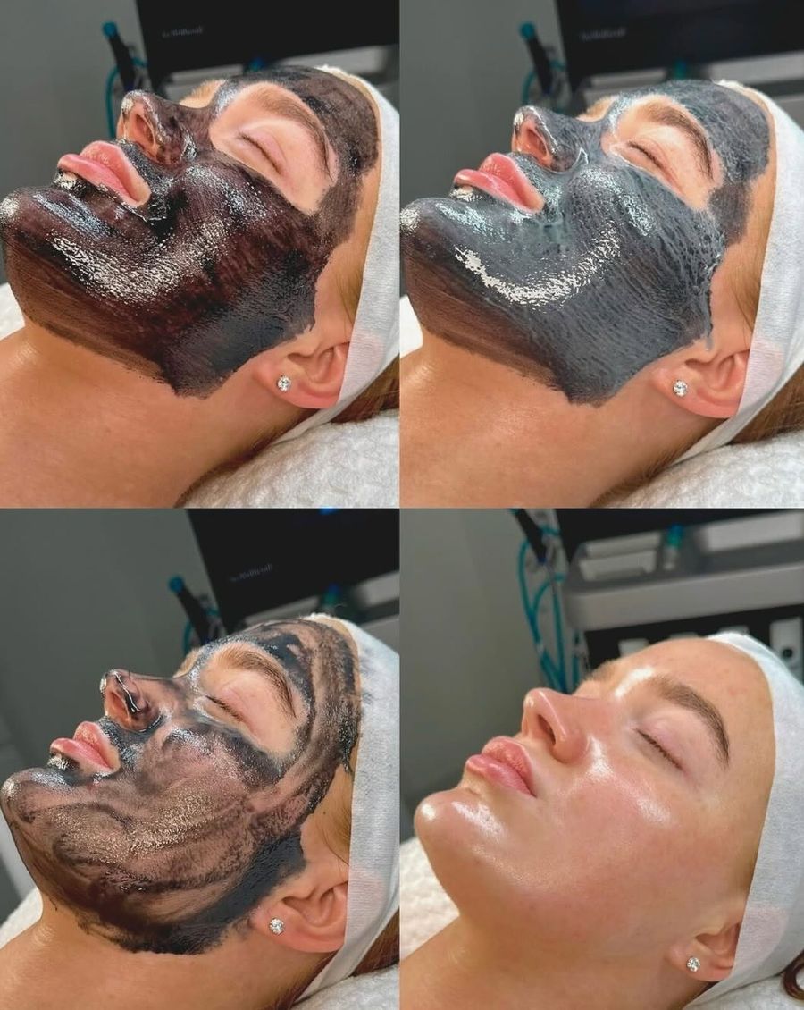 Facial de carbón Hollywood Peel