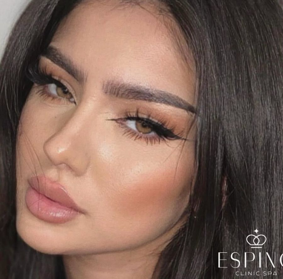 Labios definidos con ácido hialurónico